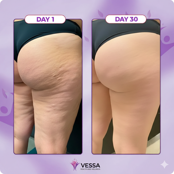 Cellulite Eraser
