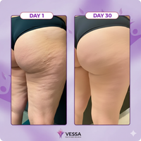 Cellulite Eraser
